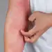 Skin Conditions